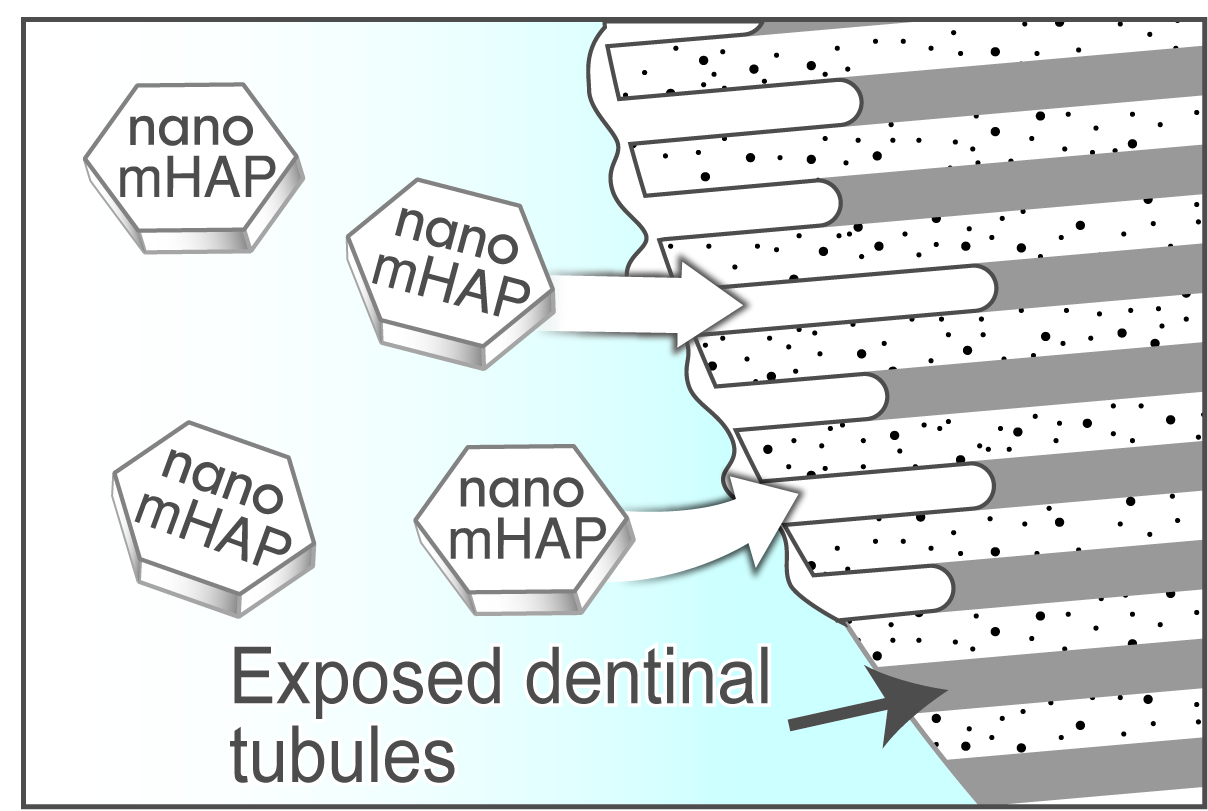 Filling and coating of exposed dentinal tubules