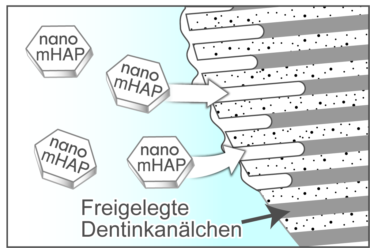 Verschluss und Versiegelung freigelegter Dentinkanälchen